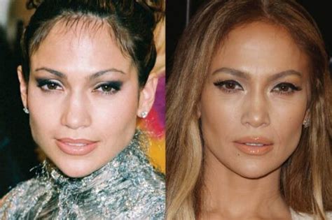 Has Jennifer Lopez Had Cosmetic Surgery Mya Cosmetic Surgery