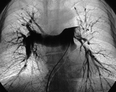 Embolia Pulmonar Por Cristina Faya Y Elisa Martínez