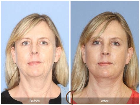 Facelift Fifties Before And After Photos Patient 50 Dr Kevin Sadati