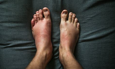Can Leggings Cause Rash On Legs And Feet