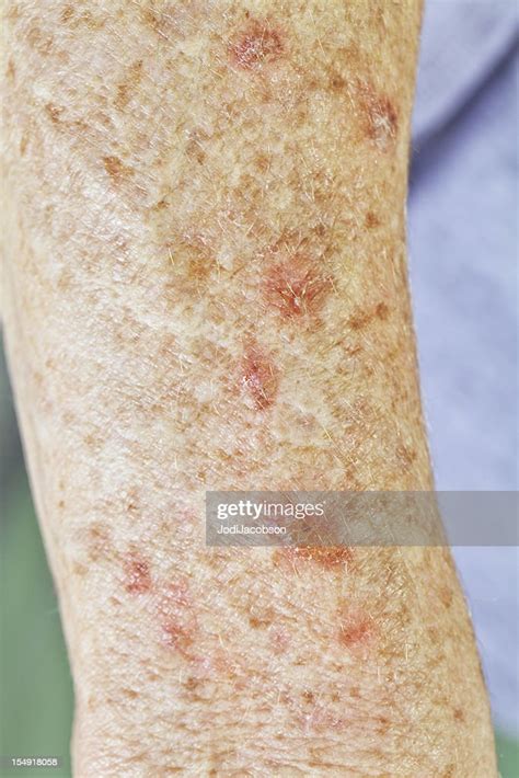 Actinic Keratosis Skin Cancer High Res Stock Photo Getty Images