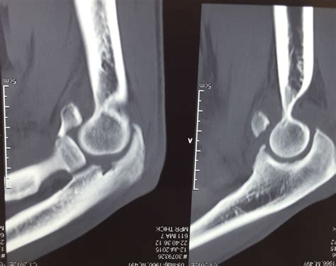 Sagittal Plane Ct Scan Showing The Radial Head Fracture And Anterior