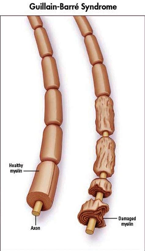 Typically, both sides of the body are involved, and the initial symptoms are changes in sensation or pain often in the back along with muscle weakness. Case study - Does regular exercise aid recovery from Guillain Barré Syndrome? | Antonino Balistreri