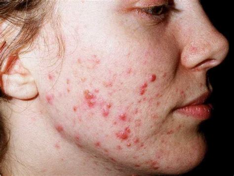 ACNE VULGARIS - Mobile Physiotherapy Clinic Ahmedabad Gujarat