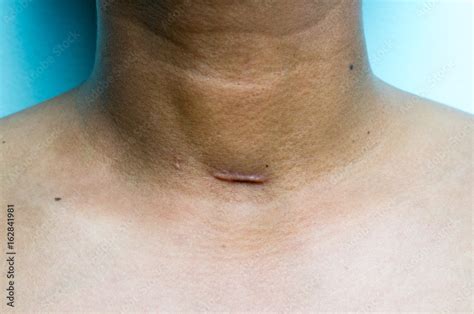 Tracheostomy Scar On Male Patient Neck After Operation Stock Photo