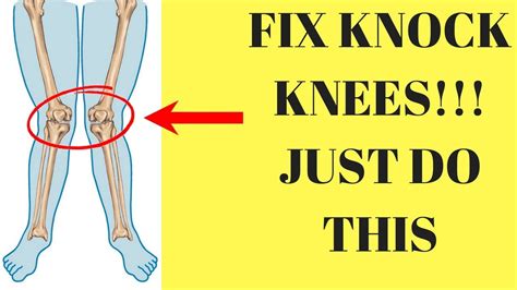 Best Exercises To Correct Knock Knees Youtube