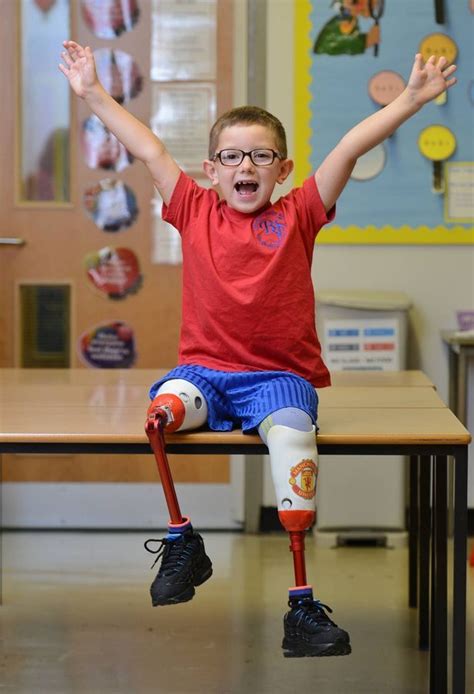 Freedom Of Mobility Pediatric Physical Therapy Prosthetic Leg Special