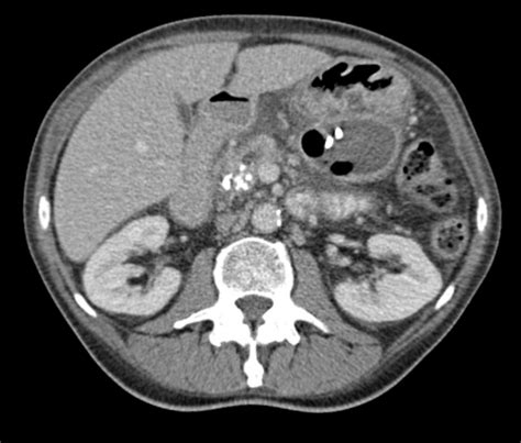 Abdominal Ct Scan With Venous Contrast Pancreatic Pseudocyst With