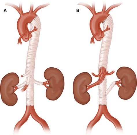 Open And Endovascular Management Of Aortic Aneurysms Circulation Research