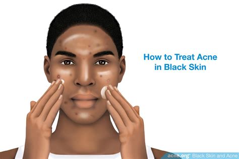 Treating Acne In Black Skin