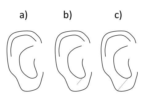 Cureus Earlobe Creases As A Marker Of The Risk For Coronary