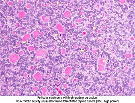 Pathology Outlines Follicular Carcinoma