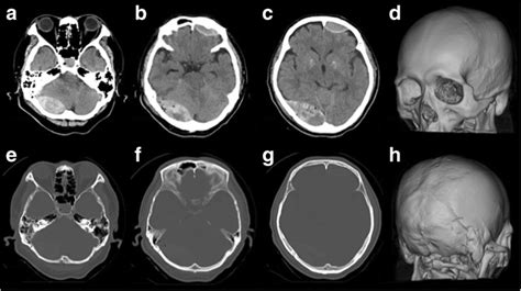 Acute contrecoup epidural hematoma that developed without ...