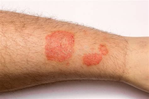Psoriasis Skin Close Up Of A Rash And Scaling On The Patient`s Stock