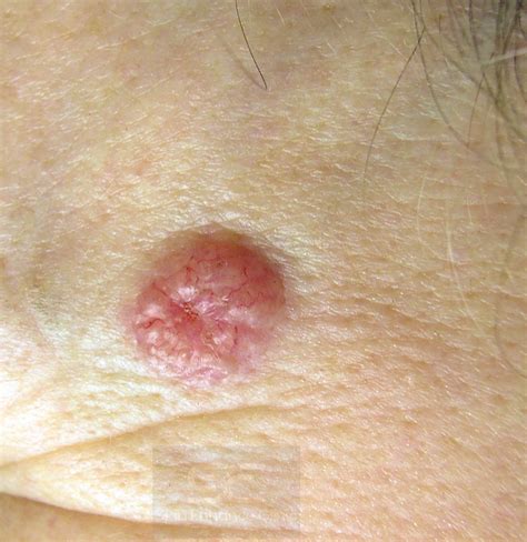 Skin Cancer And Precancerous Skin Lesions What You Need To Know Skin Enhance And Wellness