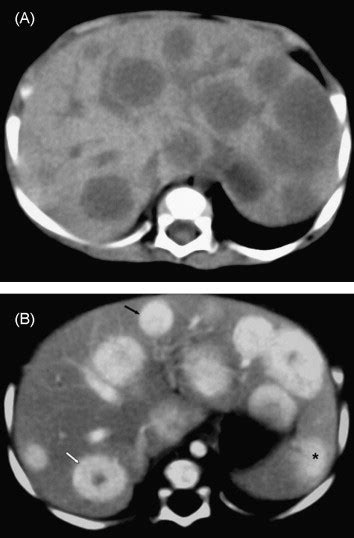 Ct And Mr Imaging Characteristics Of Infantile Hepatic