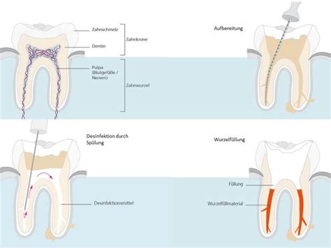 Wurzelkanalbehandlung Endodontie Zahnarztpraxis Sebastian Koch