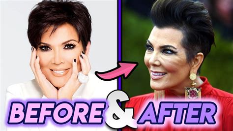 Kris Kardashian Plastic Surgery Before And After