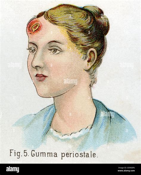 Medicine Sexually Transmitted Diseases Syphilis Gumma Periostale From Friedrich Eduard Bilz