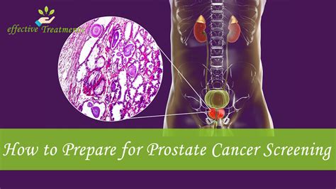 Prostate Cancer Screenings The Ultimate Psa Guide
