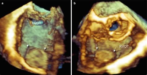 Closure Of Post Ami Ventricular Septal Defect Radiology Key