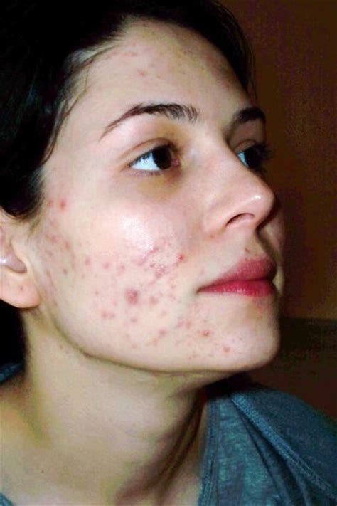 40 Best Stars With Acne Images On Pinterest Stars Famous People And