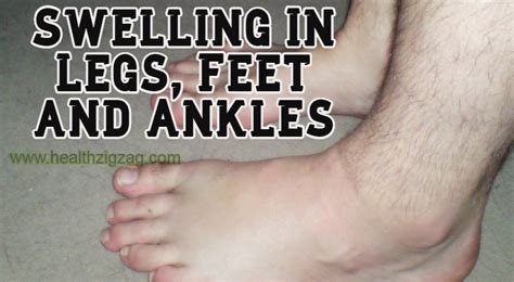 Swelling In Legs Feet And Ankles Causes Symptoms And Treatment