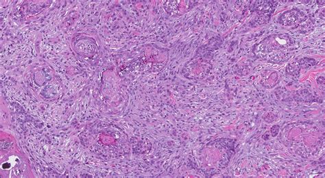 Sclerosing Basal Cell Carcinoma MyPathologyReport Ca