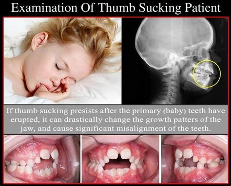 Thumb Sucking A Bad Habit Dr Nechupadam Dental Clinic