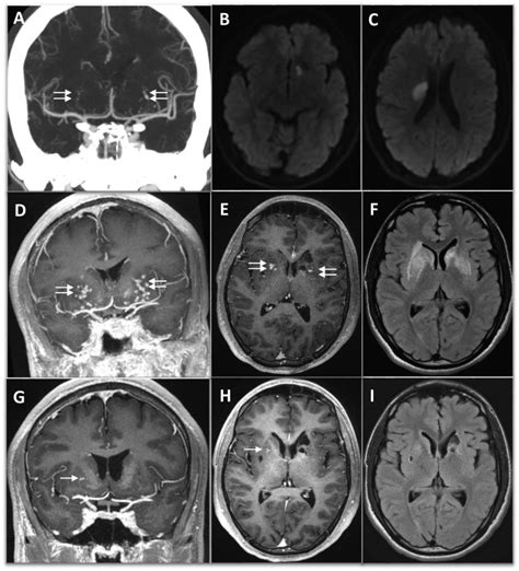 Ischemic Stroke Associated With Aneurysmal Lenticulostriate Vasculopathy And Symmetric