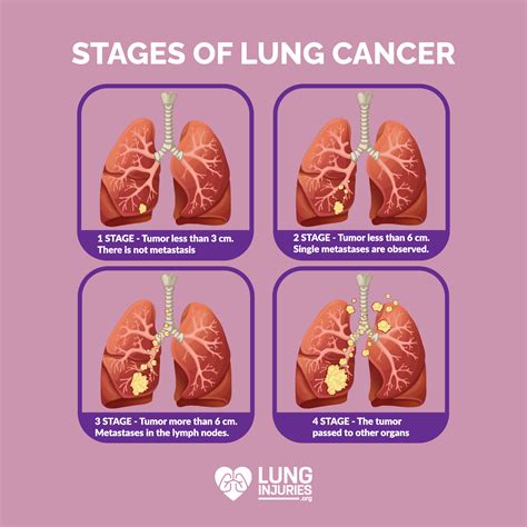 What Is Lung Cancer Symptoms Signs And More Via Pritish