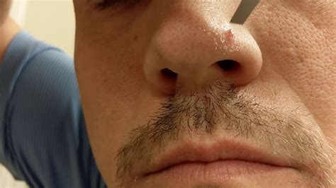 ingrown nose hair outside what are the best nose hair removal options we asked the experts