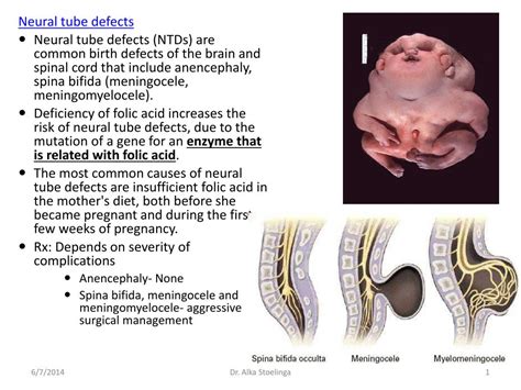 Neural Tube Defects Types And Treatments The Pulse