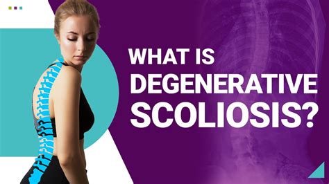 What Is Degenerative Scoliosis Youtube