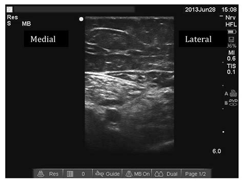 Ultrasound Guided Adductor Canal Block Saphenous Nerve Block Wfsa