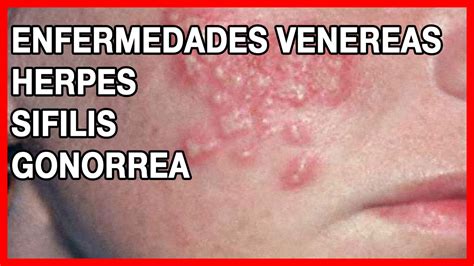 Qué Son Las Enfermedades Venereas Sifilis Herpes Y Gonorrea Youtube