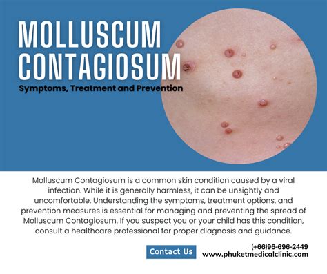 Molluscum Contagiosum Symptoms Treatment And Prevention Phuket