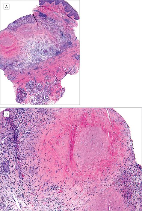 Papules In The Axillae Of A Woman Dermatology Jama Dermatology