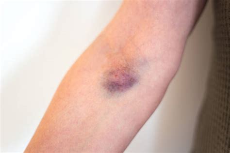 Iv Bruise Stock Photos Pictures And Royalty Free Images Istock