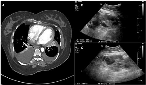 A Computerized Tomography Ct Scan Revealing Moderate Right And