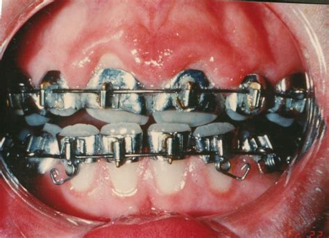 Full Bands Braces In Mid 20th Century Orthodontics Orthodontics Braces Orthodontic Appliances