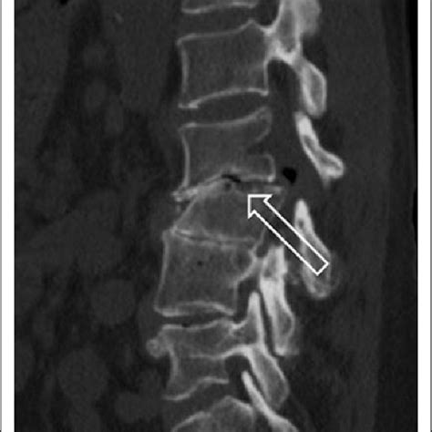 Pdf Surgical Management Of The Lumbar Spine In Rheumatoid Arthritis