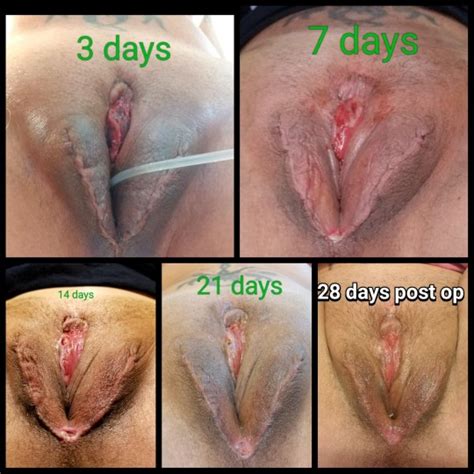 Sex Change Vagina To Penis Private Photos Homemade Porn Photos