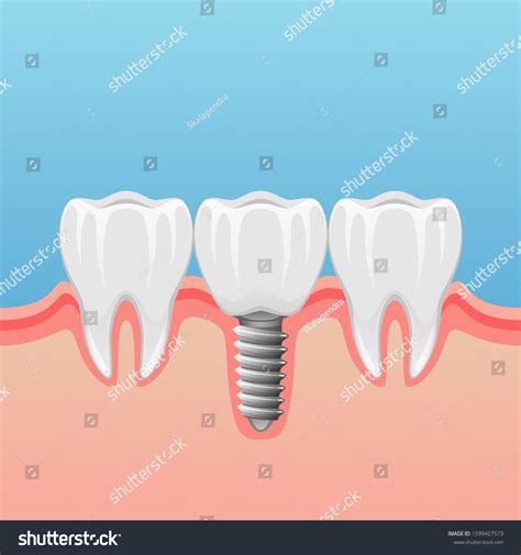 Teeth Implant Tooth Pin Dental Treatment Stock Vector Royalty Free