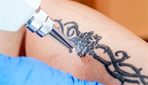 Tattoo Removal How It Works Process Healing And Scarring