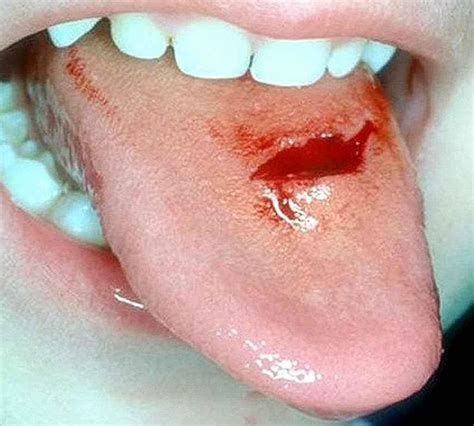 Black Spots On Tongue Causes Small Under Tongue On Tip Side Of
