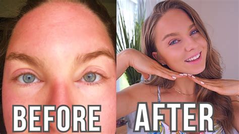 HOW I HEALED MY SUNBURN IN 2 DAYS | SEVERELY SUN BURNT & SWOLLEN FACE