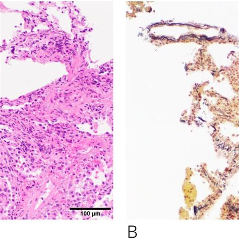 Serial Sections Of A Transbronchial Lung Biopsy Specimen Stained With