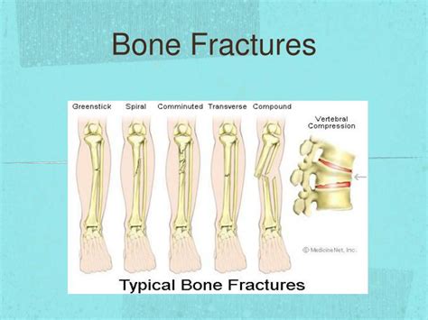 Ppt Bone Fractures Powerpoint Presentation Free Download Id2692841