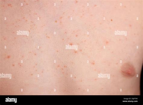 Chronic Urticaria Hi Res Stock Photography And Images Alamy